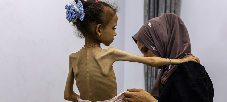 © OMS Uma menina gravemente desnutrida em Gaza. Equipes humanitárias têm apelado repetidamente a Israel para que permita a entrada de muito mais ajuda em Gaza para evitar a catástrofe humanitária em curso.
