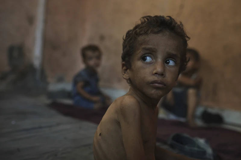 Yazan Abu Ful, uma criança desnutrida de 2 anos, está sentado em sua casa no campo de refugiados de Shati, na Cidade de Gaza, na quarta-feira, 23 de julho de 2025. (Foto AP/Jehad Alshrafi)